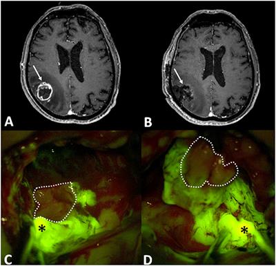 tumor cerebral frontal izquierdo